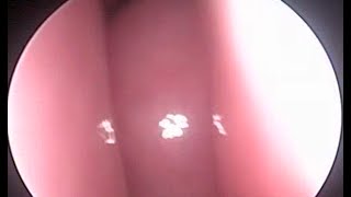 Nose Endoscopy  Allergy  Adenoid amp Deviated nasal septum [upl. by Desirae]