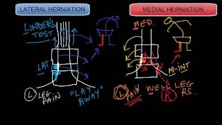 Lateral vs Medial Disc Herniations [upl. by Elokkin]