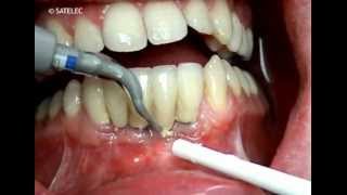 Dental Prosthetic amp Implant Maintenance PH2R and PH2L Tips [upl. by Seraphine543]