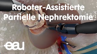 RoboterAssistierte Partielle Nephrektomie [upl. by Depoliti935]