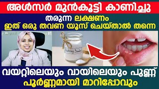 അൾസർ മുൻകൂട്ടി കാണിച്ചു തരുന്ന ലക്ഷണങ്ങൾ വായിലെയും വയറ്റിലെയും പുണ്ണ് പൂർണ്ണമായി മാറിപ്പോകും [upl. by Noivert626]