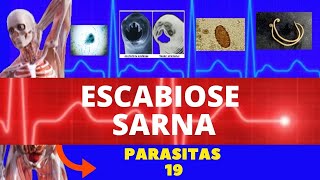 ESCABIOSE  SARNA HUMANA SARCOPTES SCABIEI HOMINIS  PARASITOLOGIA  INFECTOLOGIA [upl. by Lalittah]