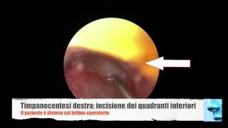 Otite media cronica glue ear aspirazione di secrezioni dalla cassa del timpano [upl. by Ahseyd]