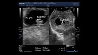 Ultrasound Video showing a case of missed miscarriage of about 7 to 8 weeks [upl. by Steffi700]