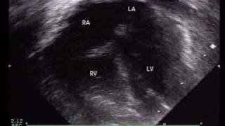 Anomalous Pulmonary Venous ReturnPartial [upl. by Assennav296]