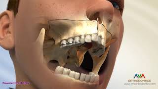 Surgical Orthodontic Treatment for Constricted Upper Jaw  SARPE [upl. by Aggarwal]