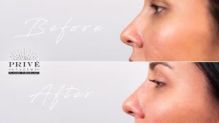 Plasma Fibroblast  Prive Academy  Nose Contouring Technique [upl. by Vokay914]