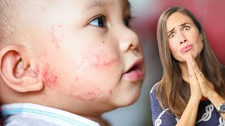 Baby Eczema What Does it Look Like AND How to Treat it NATURALLY PICTURES [upl. by Grosvenor]