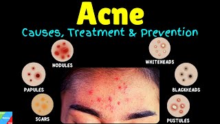 Acne Types Causes Treatment amp Prevention – Acne Vulgaris  Pimples [upl. by Mani608]