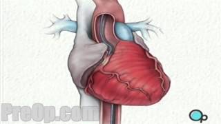 Balloon Angioplasty Coronary Angioplasty  PreOp® Patient Education Medical HD [upl. by Erminia]