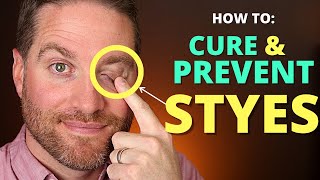 How To CURE And PREVENT STYES Get Rid Of A Hordeolum stye And Chalazion Fast [upl. by Kathie]