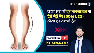 Can Bow Legs Be Corrected With Exercises Bow Legs Correction In Delhi NCR amp Agra  Dr DP Sharma [upl. by Blunt]