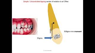 Basics of Biomechanics 2 types of tooth movement and couple [upl. by Gniw317]