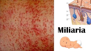 Miliaria Heat rash [upl. by Cesaro]