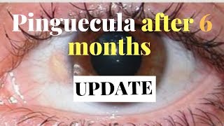 How I fight pinguecula yellow spot on eyes after 6 months updateNO MORE RADISH JUICE [upl. by Koosis]