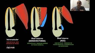 Gengivectomia ou Retalho para realizar Cirurgia de Aumento de Coroa Clínica [upl. by Hailahk560]