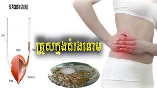 ជម្ងឺគ្រួសតម្រងនោម​  Lithiasis Renal or Calcul Renal [upl. by Esiuqcaj]