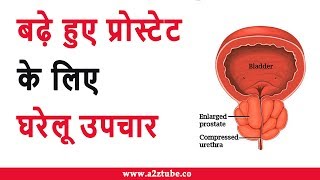 Home Remedies for Enlarged Prostate in Hindi  बढ़े हुए प्रोस्टेट के लिए घरेलू उपचार [upl. by Stanfill]