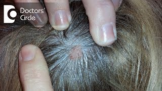 What does small skin colored lump on the scalp indicate  Dr Urmila Nischal [upl. by Yrek343]