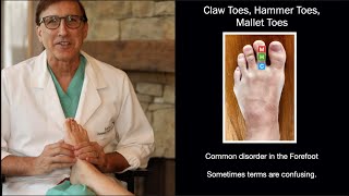 Claw Toe Hammer Toe Mallet Toe [upl. by Tracey]