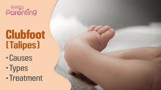 Club Foot Talipes in Babies  Causes Signs amp Treatment [upl. by Jobye]