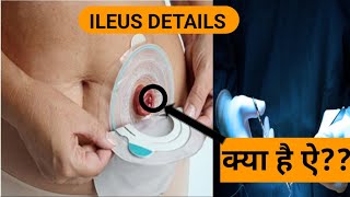 understanding ILEUS [upl. by Naashar846]