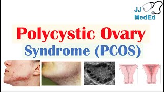 Polycystic Ovary Syndrome PCOS  Causes Risks and Treatments [upl. by Tingley161]