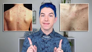 How to Get Rid of Body Acne [upl. by Mairam435]