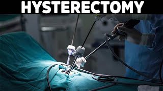 Think Twice before Getting a Hysterectomy [upl. by Nnylasor]