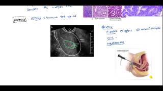 Endometrial Cancer and Hyperplasia for USMLE [upl. by Auos]