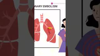 Pulmonary Embolism Explained What Every Med Student Needs to Know PulmonaryEmbolism medstudent [upl. by Federica742]