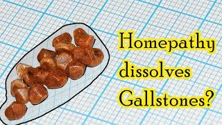 Can homeopathic medicine dissolve gallstones  Dr Sanjay Panicker [upl. by Liborio]