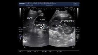 Ultrasound Video showing Cystic lesions in perinephric space known as lymphangiectasia [upl. by Ahsilat]