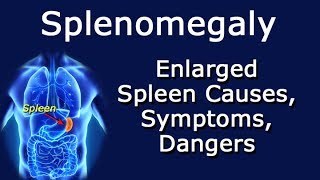 Splenomegaly Enlarged Spleen Causes Symptoms Dangers [upl. by Boycey647]