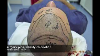 Hair Transplant Turkey REPAIR HAIR TRANSPLANT FUE 3340 GRAFTS [upl. by Kirven]