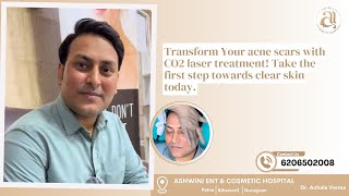 CO2 Laser Treatment Your Complete Guide to Youthful Skin Dr Achala Verma [upl. by Notkcorb]