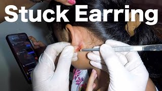 Earring Stuck Inside Her Earlobe for Months  How Its Removed [upl. by Olbap]