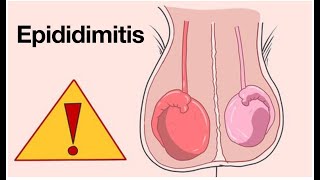 Epididimitis  Causas y tratamiento  Dolor testicular  Infección testicular [upl. by Anecuza]