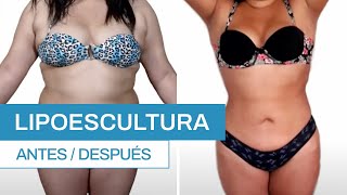 ¿Cómo es una Lipoescultura Antes y después  Clínica Barrenechea [upl. by Seyer]