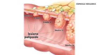 Resezione endoscopica di lesione polipoide del colonstomaco [upl. by Suivat]