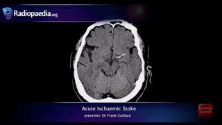 Stroke Acute infarction  radiology video tutorial CT MRI angiography [upl. by Neau]