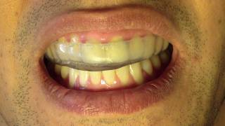 Bruxism Splint  Part 6  Insertion and Occlusion [upl. by Tutankhamen]