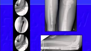 Complex Forearm Fractures [upl. by Elfreda]