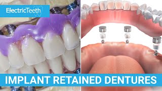 Implant retained dentures explained [upl. by Eirolav358]