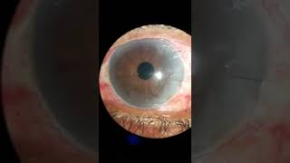 Decentered Intraocular lens due to broken haptic1 [upl. by Oznarol]