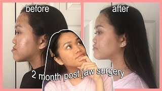 2 MONTH POST JAW SURGERY  before amp after [upl. by Sixele]