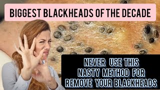 Nasty and lengthy blackhead removal bent needle historical method DrAMAZINGSKIN [upl. by Aiseneg]