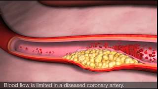 Angina and coronary heart disease [upl. by Damali185]