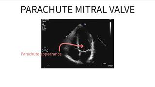 Parachute mitral valve [upl. by Netsreik]