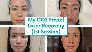 I FINALLY Got CO2 Fraxel Laser for my Atrophic Acne Scars Recovery Vlog  michxmash [upl. by Ettenirt331]